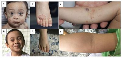 Wiskott-Aldrich Syndrome (WAS) and Dedicator of Cytokinesis 8- (DOCK8) Deficiency